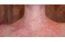 Alerji Vücutta Kızarıklık Neden Olur? Alerji Vücutta Kızarıklık Neden Olur?