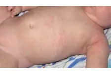 Bebeklerde Vücutta Kızarıklık Belirtileri ve Tedavisi