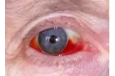 Göz Kızarıklığı Nedenleri