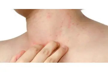 Deride Kaşıntı ve Kızarıklık Belirtileri ve Tedavisi