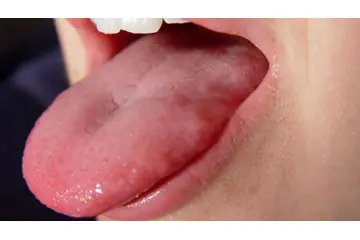Dilde Kızarıklık Belirtileri ve Tedavisi