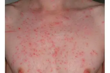 Göğüste Kızarıklık Nedenleri?