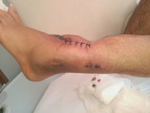 Bacakta Kızarıklık ve Sertlik Belirtileri ve Tedavisi