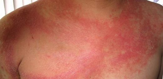 Bebek Vücudunda Kızarıklık Belirtileri ve Tedavisi