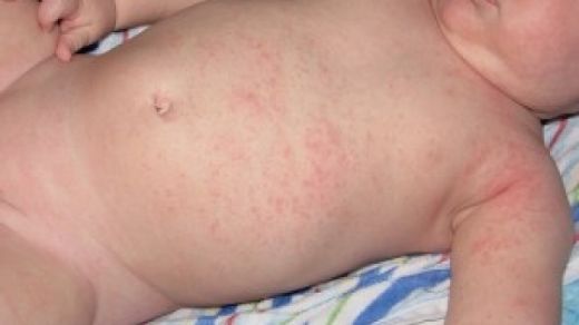 Bebeklerde Vücutta Kızarıklık Belirtileri ve Tedavisi