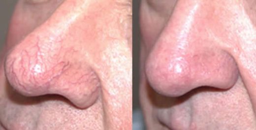 Burun Kızarıklığında Tedavi