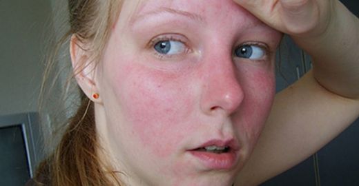 Cilt Kızarıklığına Ne İyi Gelir?