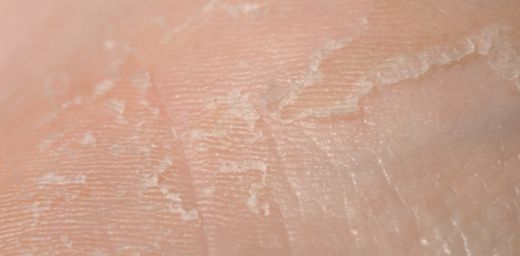 Ciltte Kızarıklık ve Pullanma Nedenleri Nelerdir?