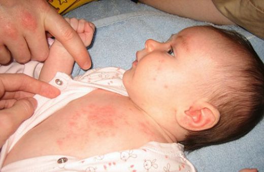 Çocuklarda Vücutta Kızarıklık Belirtileri ve Tedavisi