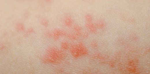 Deride Kızarıklık Belirtileri ve Tedavisi