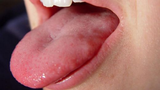 Dilde Kızarıklık Belirtileri ve Tedavisi