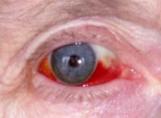 Göz Kızarıklığı Nedenleri