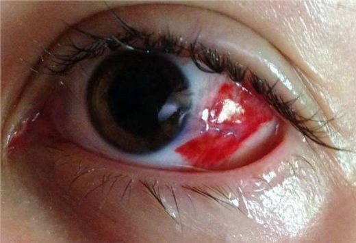 Göz Kızarıklığına Ne İyi Gelir?