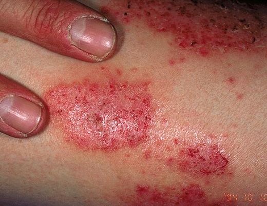 Kolda Kızarıklık Lenfödemde Tedavi Nasıl Olmalıdır?