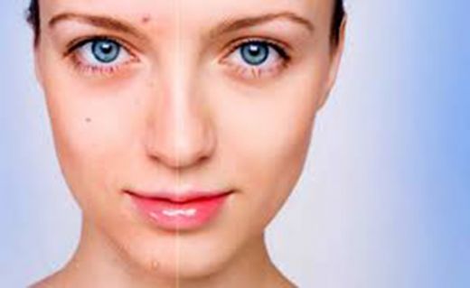 Sivilce Kızarıklığı Tedavi Yöntemleri