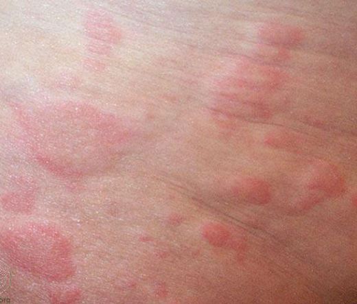 Vücutta Kaşıntı ve Kızarıklık Sebepleri