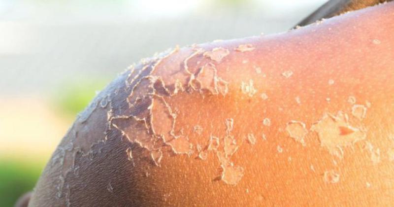 Güneş Kızarıklığı Nasıl Geçer?